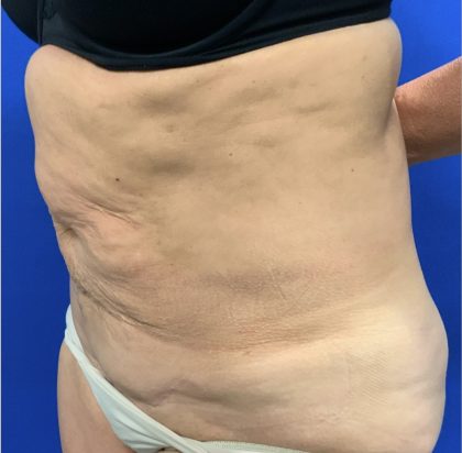 Tummy Tuck Before & After Patient #2549