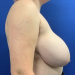 Breast Reduction With Galaflex Before & After Patient #2735