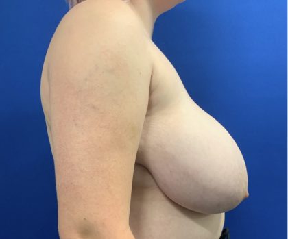 Breast Reduction With Galaflex Before & After Patient #2735