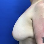 Breast Reduction With Galaflex Before & After Patient #2736