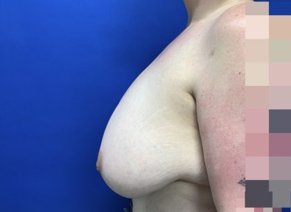 Breast Reduction With Galaflex Before & After Patient #2736