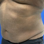 Emsculpt Neo Before & After Patient #2793