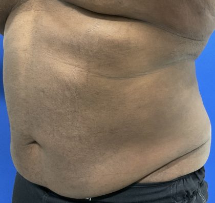 Emsculpt Neo Before & After Patient #2793