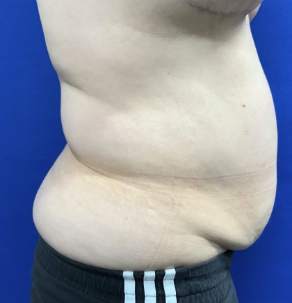 Wellness Program Before & After Patient #2800