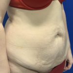Tummy Tuck Before & After Patient #2550