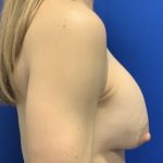 Implant Exchange Due to Ruptured Silicone Before & After Patient #2811