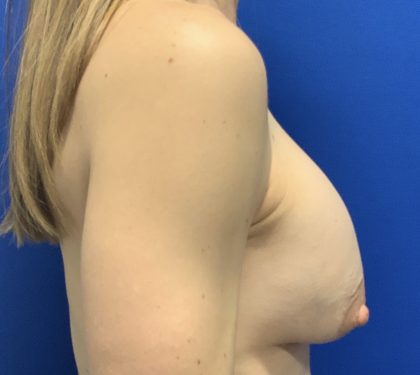 Implant Exchange Due to Ruptured Silicone Before & After Patient #2811