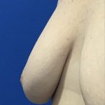 Inverted Nipple Correction with Galaflex Before & After Patient #2874