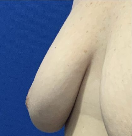 Inverted Nipple Correction with Galaflex Before & After Patient #2874