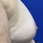Inverted Nipple Correction with Galaflex Before & After Patient #2875