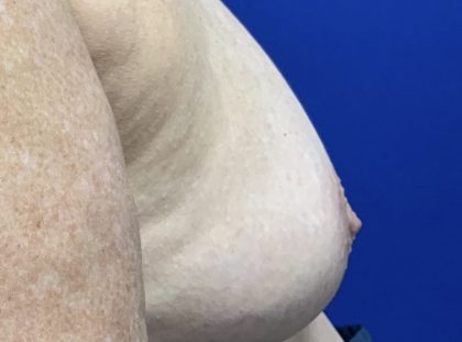Inverted Nipple Correction with Galaflex Before & After Patient #2875