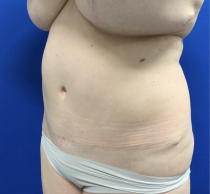 Liposuction Before & After Patient #2888