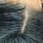 PRP For Hair Restoration Before & After Patient #2902