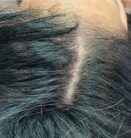 PRP For Hair Restoration Before & After Patient #2902