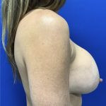 Implant Removal with Capsulectomy Before & After Patient #2911