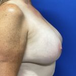 Implant Removal with Capsulectomy Before & After Patient #2913