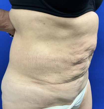 Tummy Tuck Before & After Patient #2547