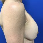 Implant Removal with Capsulectomy Before & After Patient #2915