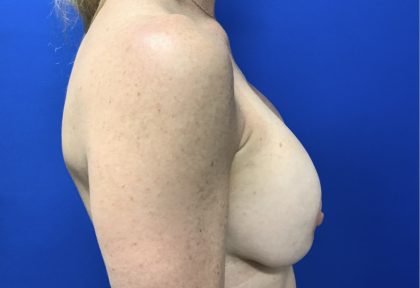 Implant Removal with Capsulectomy Before & After Patient #2915