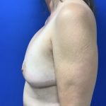 Implant Removal with Capsulectomy Before & After Patient #2916