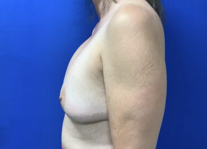 Implant Removal with Capsulectomy Before & After Patient #2916