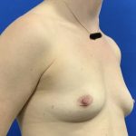 Breast Augmentation Before & After Patient #2633