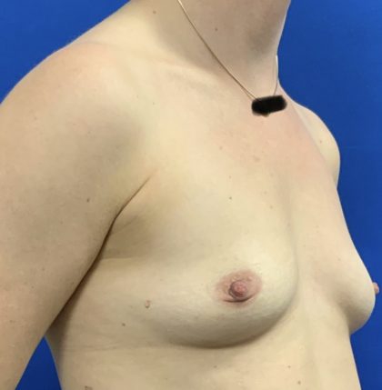 Breast Augmentation Before & After Patient #2633