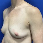 Breast Augmentation Before & After Patient #2632