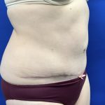 Tummy Tuck Before & After Patient #2548