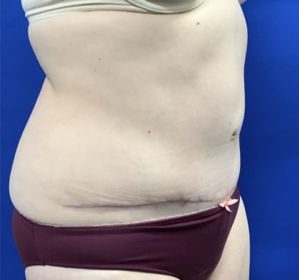 Tummy Tuck Before & After Patient #2548