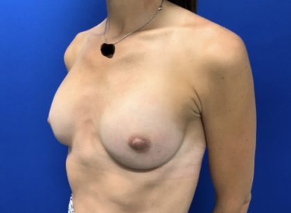 Breast Augmentation Before & After Patient #2666