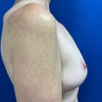 Breast Reduction With Galaflex Before & After Patient #2733