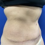 Tummy Tuck Before & After Patient #2547