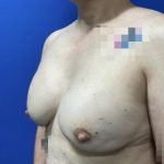 Breast Reconstruction with Direct to Implant with Silicone Implants Before & After Patient #2701
