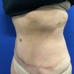 Tummy Tuck Before & After Patient #2549