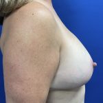Breast Reduction With Galaflex Before & After Patient #2731