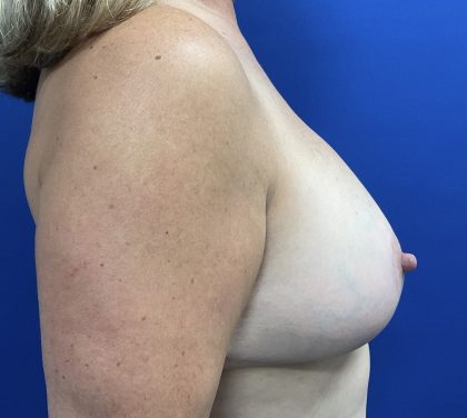 Breast Reduction With Galaflex Before & After Patient #2731