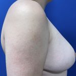 Breast Reduction With Galaflex Before & After Patient #2735