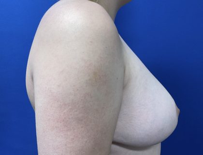 Breast Reduction With Galaflex Before & After Patient #2735