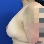 Breast Reduction With Galaflex Before & After Patient #2736