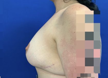Breast Reduction With Galaflex Before & After Patient #2736