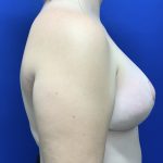 Breast Reduction With Galaflex Before & After Patient #2772