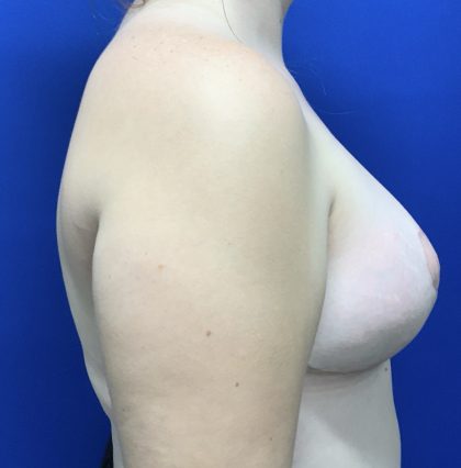 Breast Reduction With Galaflex Before & After Patient #2772