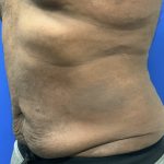 Emsculpt Neo Before & After Patient #2793