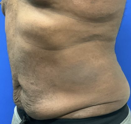 Emsculpt Neo Before & After Patient #2793