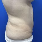Wellness Program Before & After Patient #2800