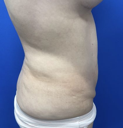 Wellness Program Before & After Patient #2800