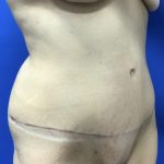 Tummy Tuck Before & After Patient #2550