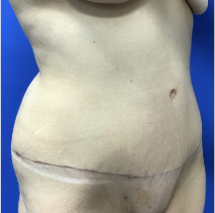 Tummy Tuck Before & After Patient #2550