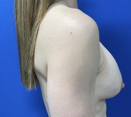 Implant Exchange Due to Ruptured Silicone Before & After Patient #2811